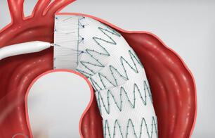 Home | Aortic Intervention