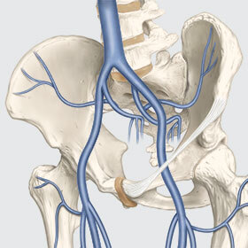 Embolization an option for underdiagnosed pelvic congestion syndrome ...